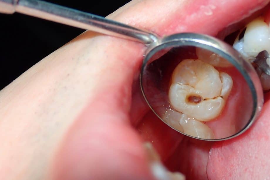 Can You Reverse Tooth Decay?
