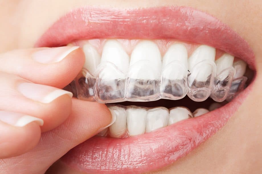How Does Invisalign Correct An Overbite?