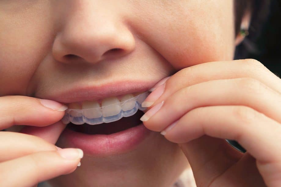 Invisalign vs At-Home Aligners: What's Best for Adults in Torrance, CA?