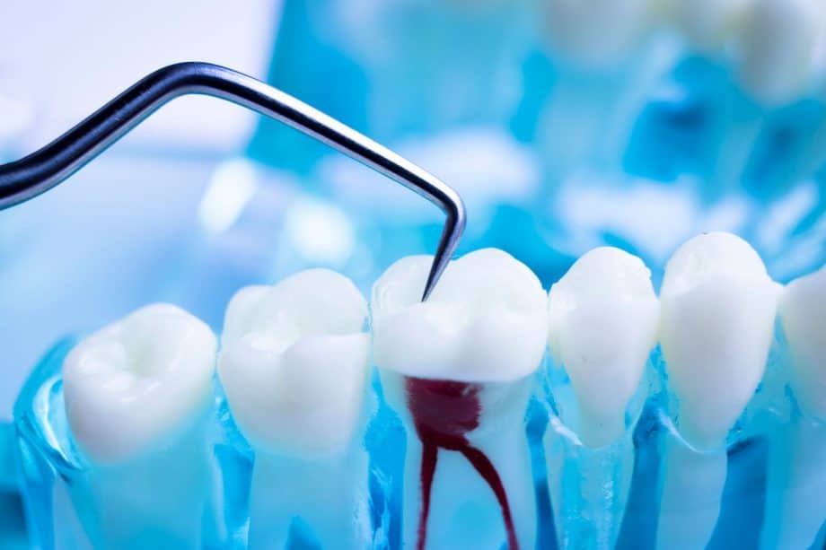 What Happens During a Root Canal?