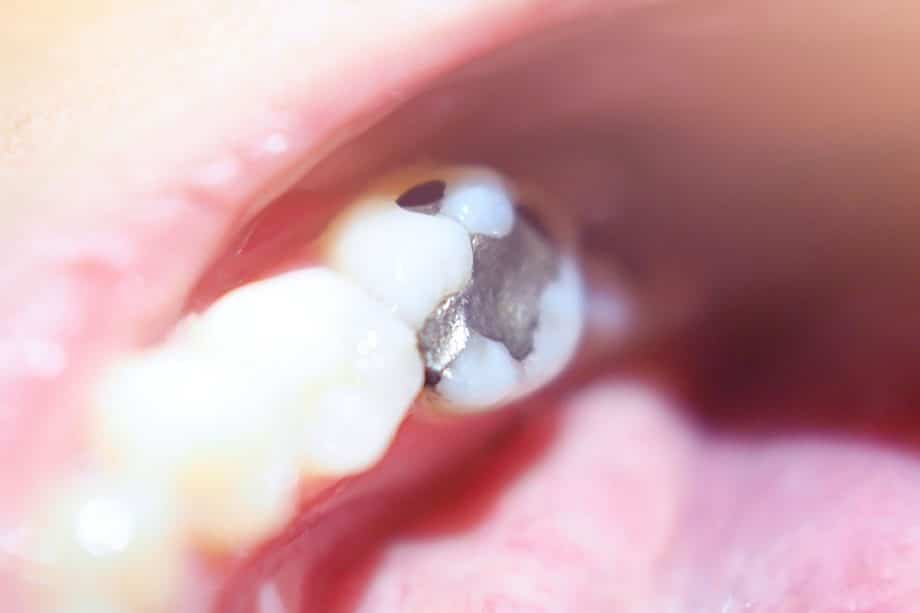 Should I Remove Silver Fillings?